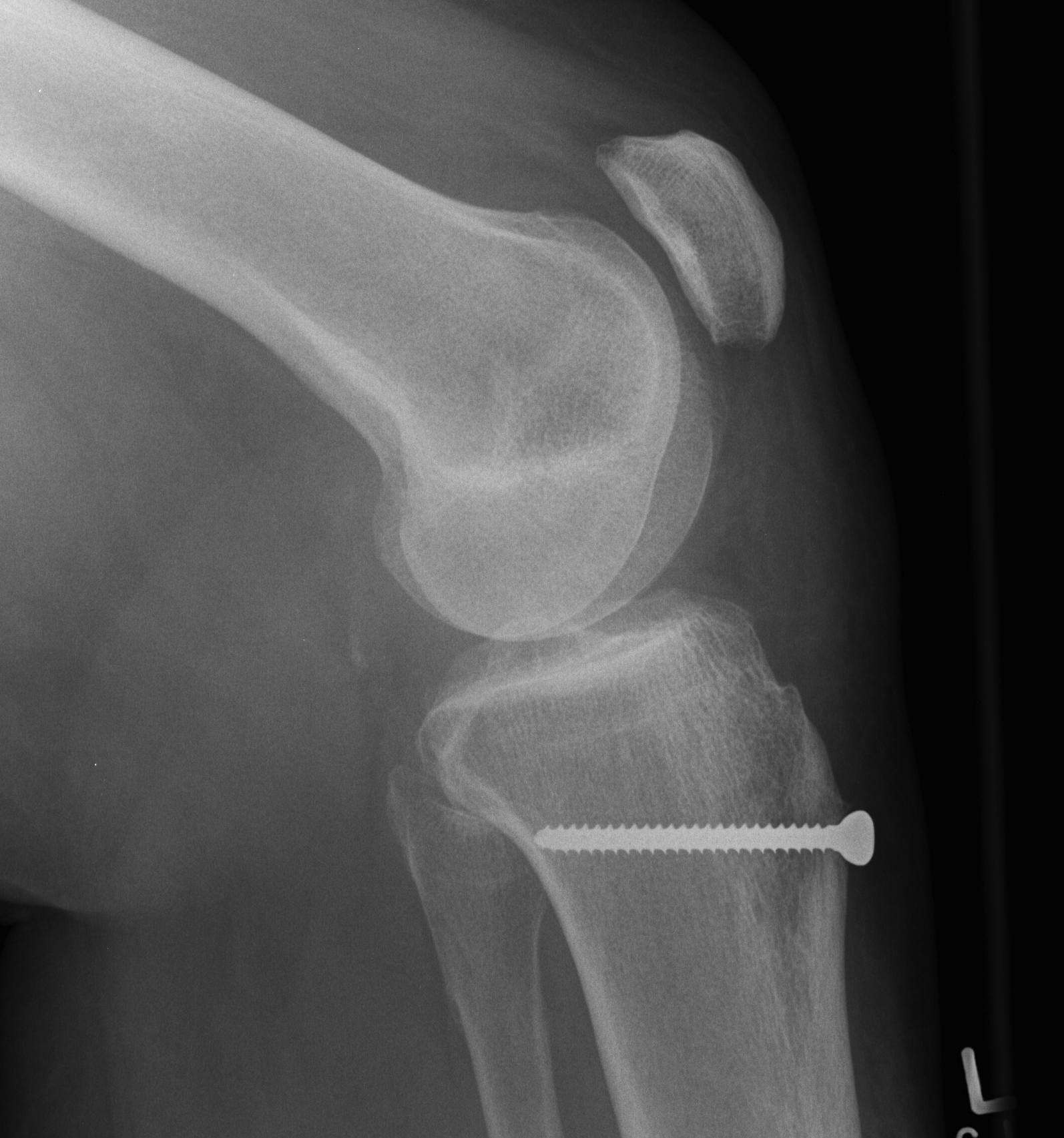 Fulkerson Osteotomy Lateral
